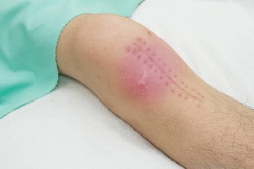 failed knee surgery