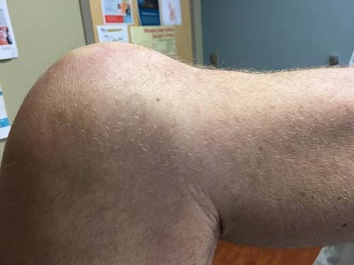 PCL Tear
