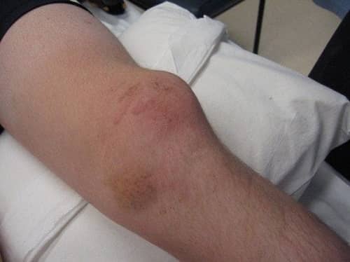 Patella Dislocation