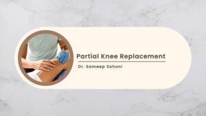 Partial Knee Replacement