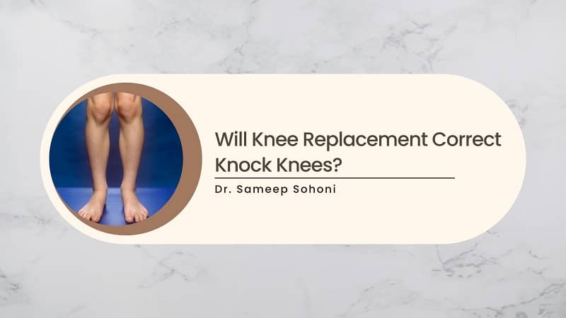 Will Knee Replacement Correct Knock Knees