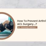 How To Prevent Arthritis After ACL Surgery